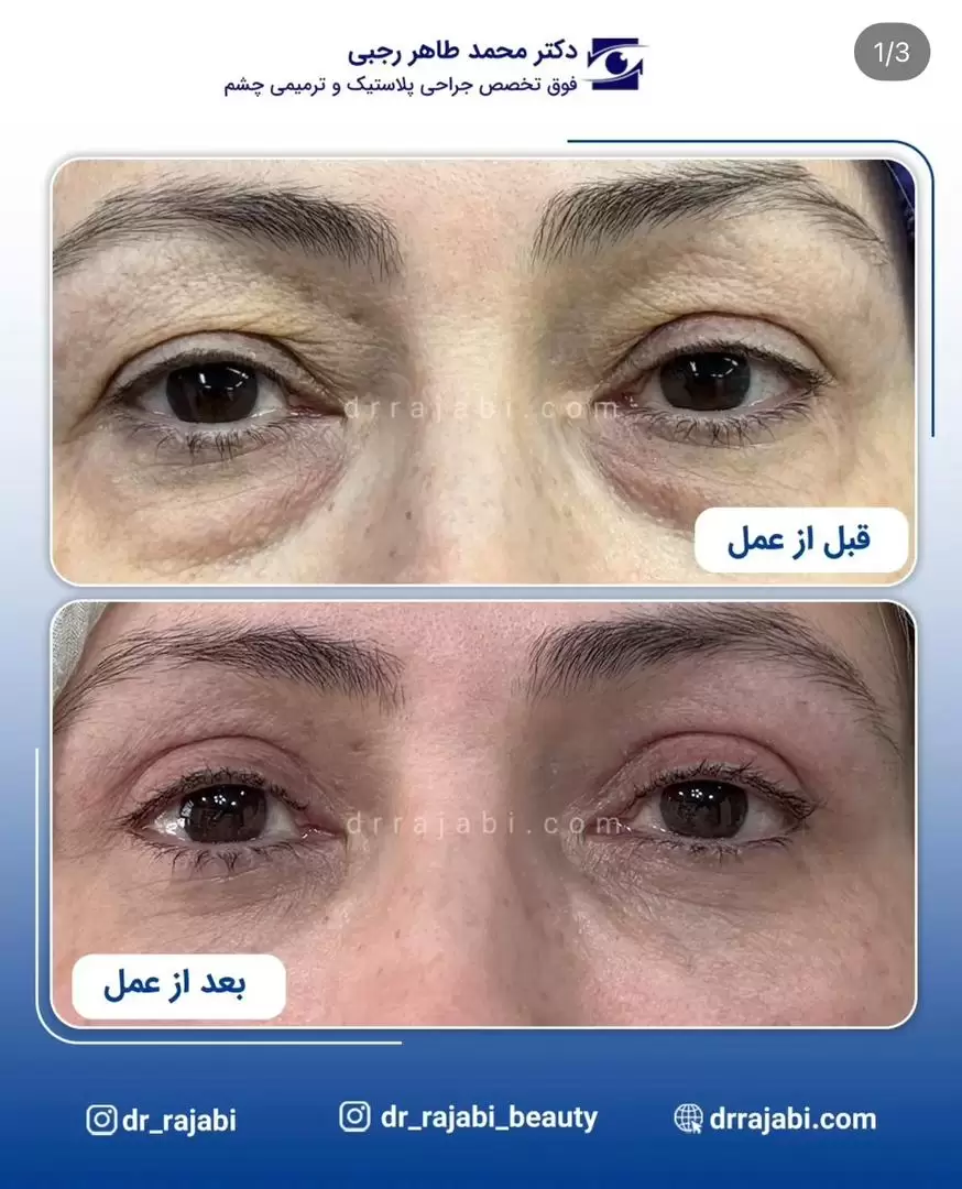نمونه کار جراحی پلک